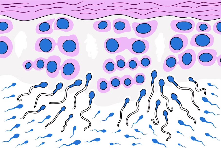 Spermatozoidlarning külotlarga oqib tushishi (kesilgan)